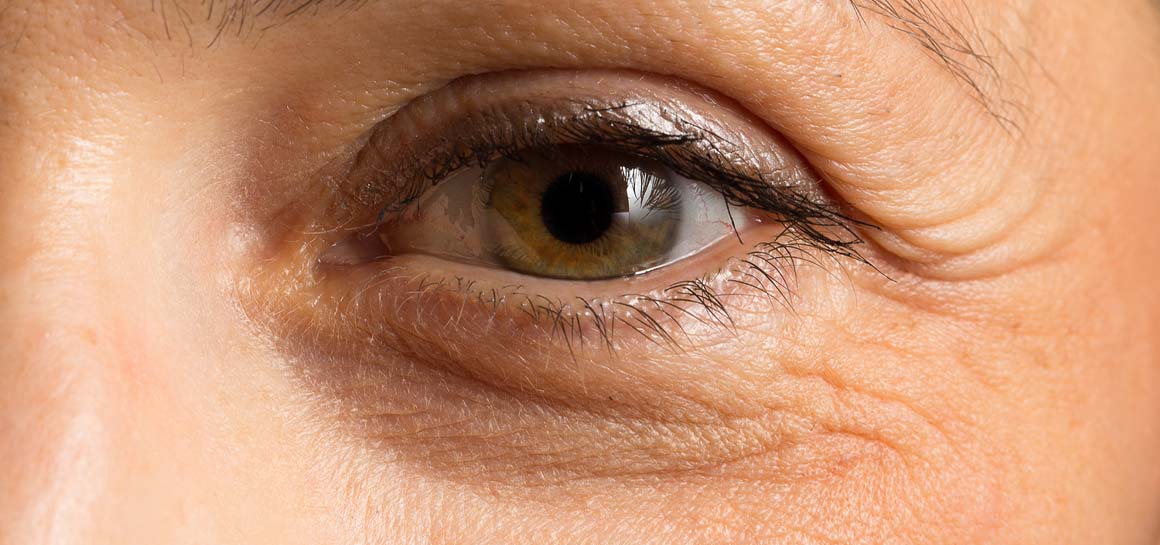 How to Treat Dark Circles Under the Eyes
