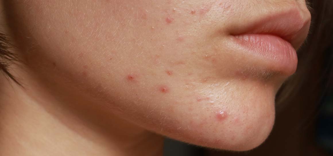 How to treat period acne