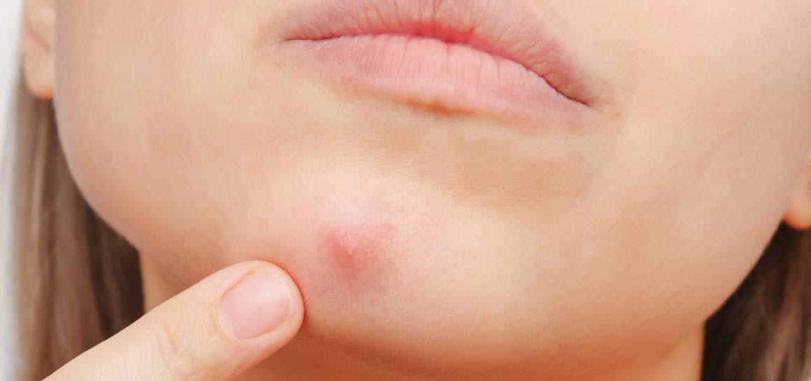 How to treat blind pimples